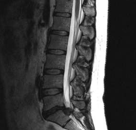 Opzioni di diagnosi per l'osteocondosi lombare