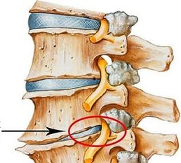 Perché l'osteocondosi lombare è