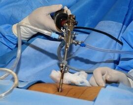 Trattamento chirurgico dell'osteocondosi lombare