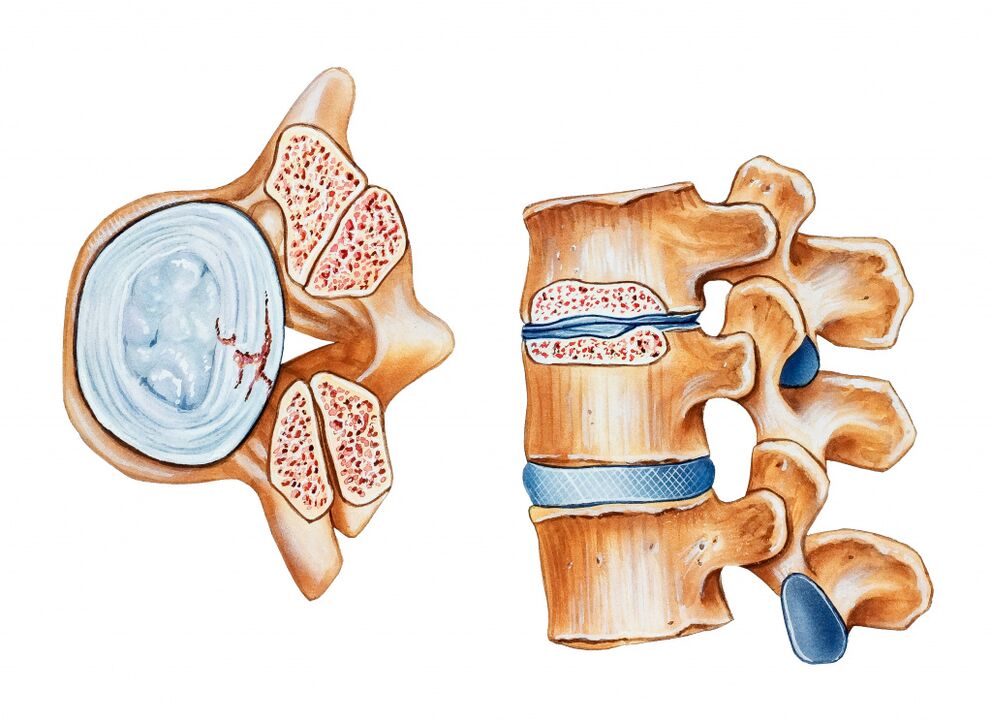 L'osteocondosi della regione di cervice porta alla distruzione dei dischi intermedi dell'intermedio