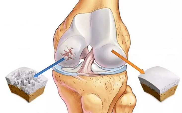 Cartilagine sana e osteoartrite dell'articolazione